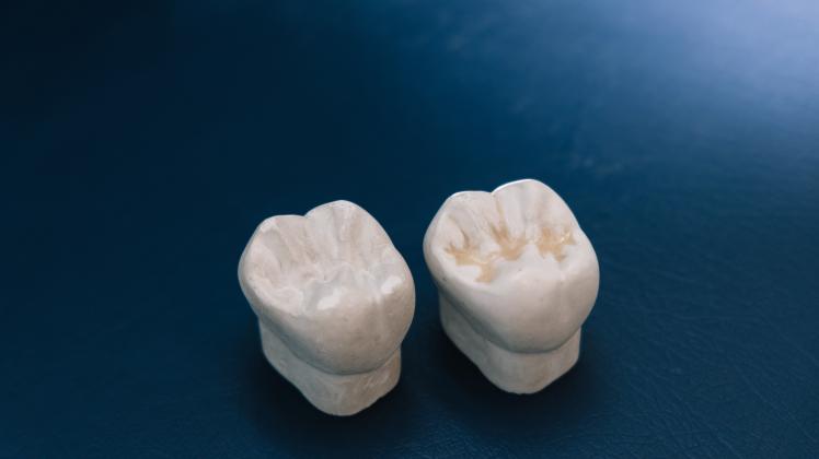 En tand med og uden lakering